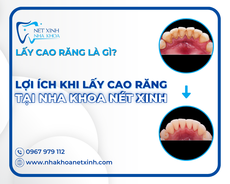 Địa chỉ cạo vôi răng tốt nhất Bình Tân