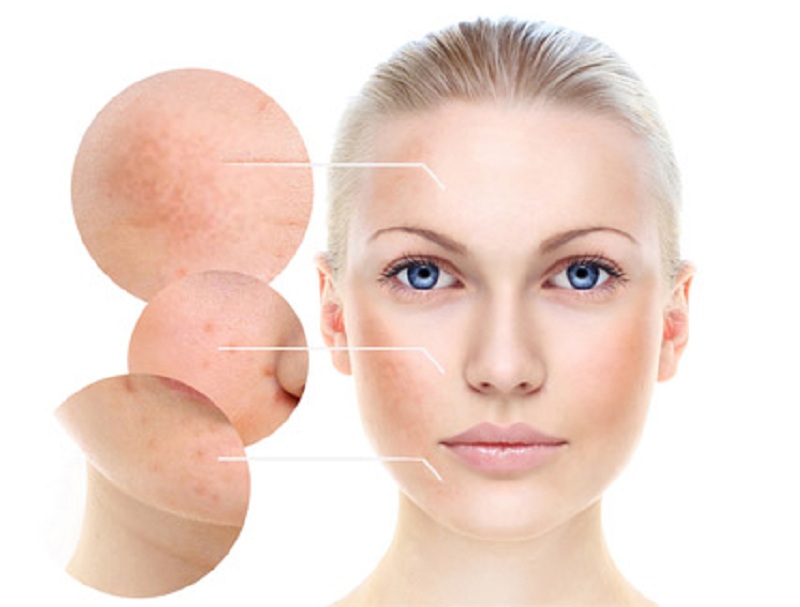 TOP 3 SPA ĐIỀU TRỊ NÁM TÀN NHANG TẠI QUẬN 12