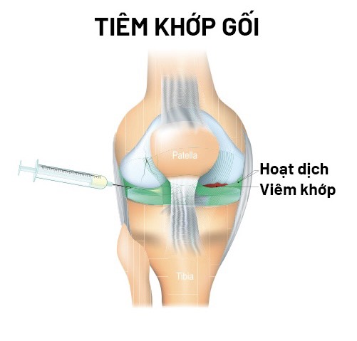 Tiêm Chất Nhờn Khớp Gối tại Phòng Khám B.S Chuyên Khoa I Phạm Đình Tĩnh