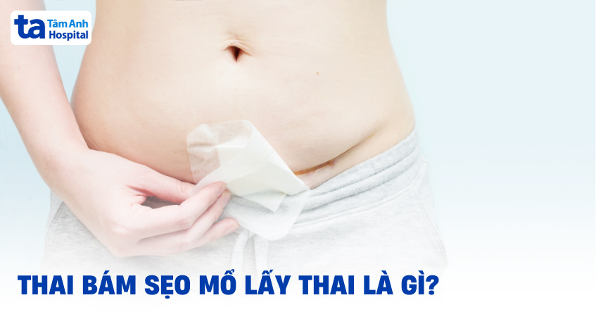 Thai Bám Sẹo Mổ Lấy Thai: Nguy Cơ Tiềm Ẩn Và Giải Pháp Điều Trị Hiệu Quả