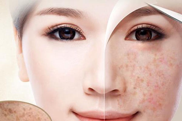 SPA ĐIỀU TRỊ NÁM TÀN NHANG 03