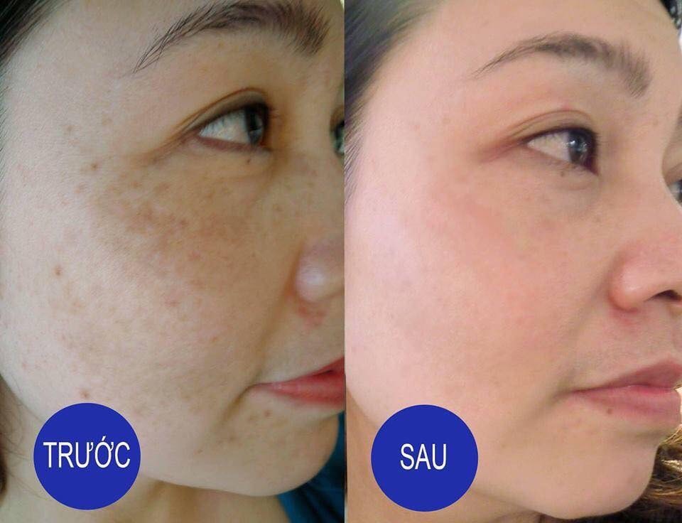SPA ĐIỀU TRỊ NÁM TÀN NHANG 05