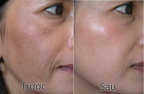 SPA ĐIỀU TRỊ NÁM TÀN NHANG 02