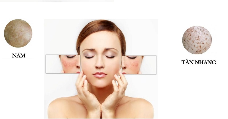 SPA ĐIỀU TRỊ NÁM TÀN NHANG 02