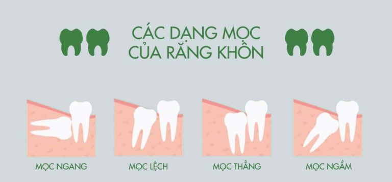 - Top 5 Phòng Khám Nhổ Răng Khôn An Toàn Tại Quận Bình Tân TP HCM