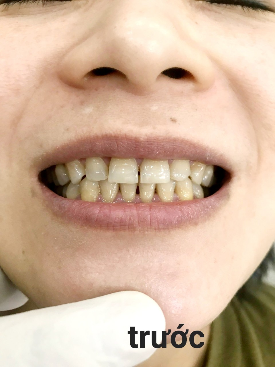 hình trước khi làm nha khoa thái anh