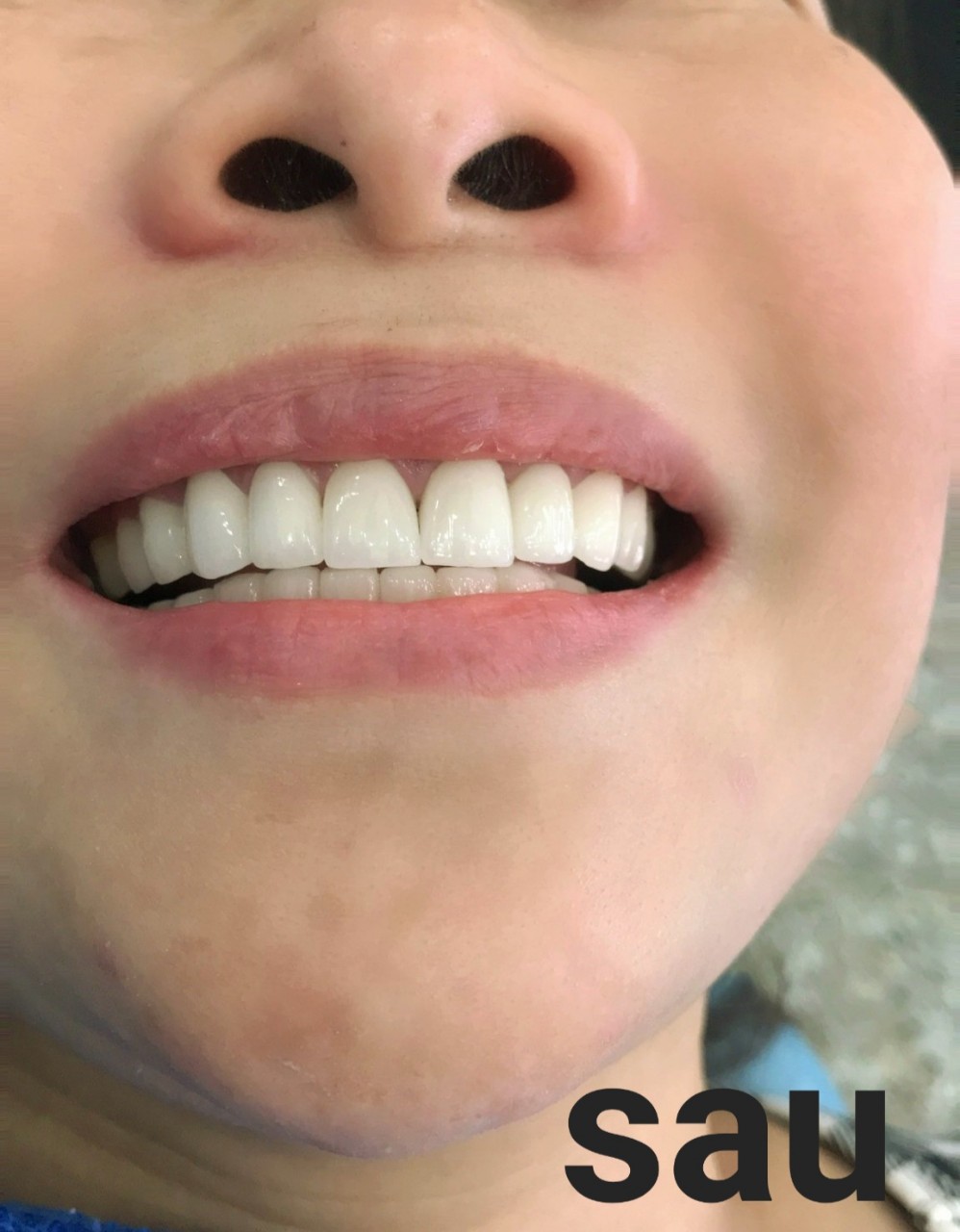 hình ảnh sau khi đến nha khoa thái anh