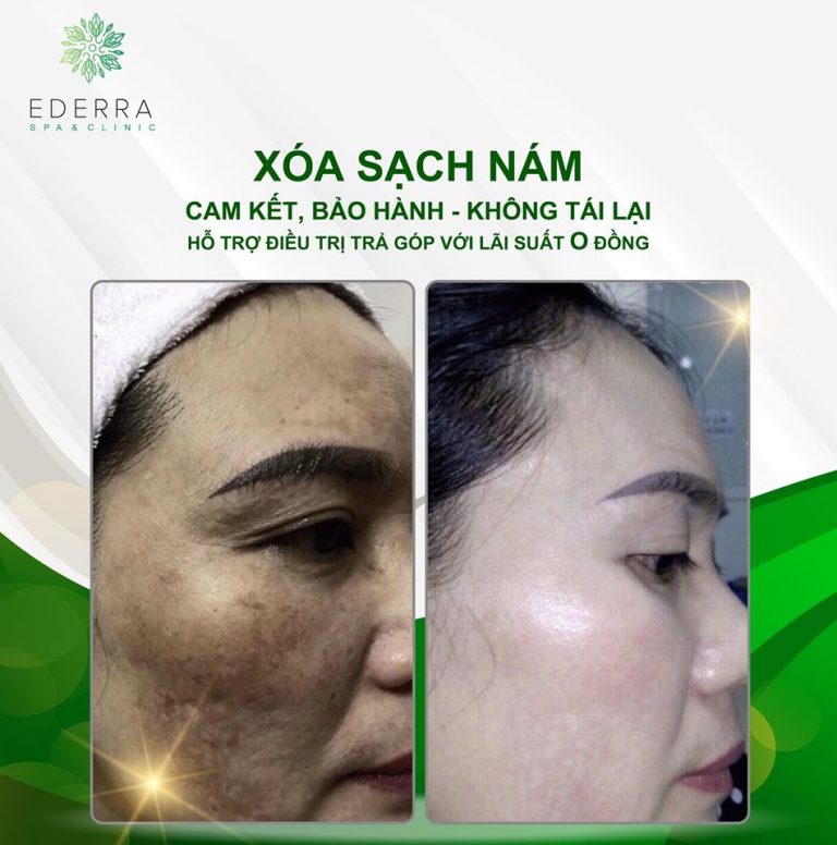 Điều trị bám chuyên sâu tại SB E'DerraClinics 