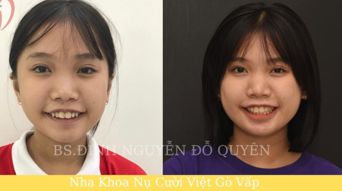 TOP 3 DỊCH VỤ KHÁM RĂNG 5 SAO BẬC NHẤT TẠI TÂN BÌNH, HỒ CHÍ MINH