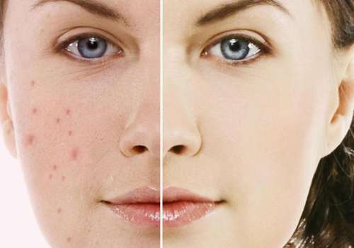 Top 3 Spa Trị Mụn Sài Gòn An Toàn Chất Lượng Nhất