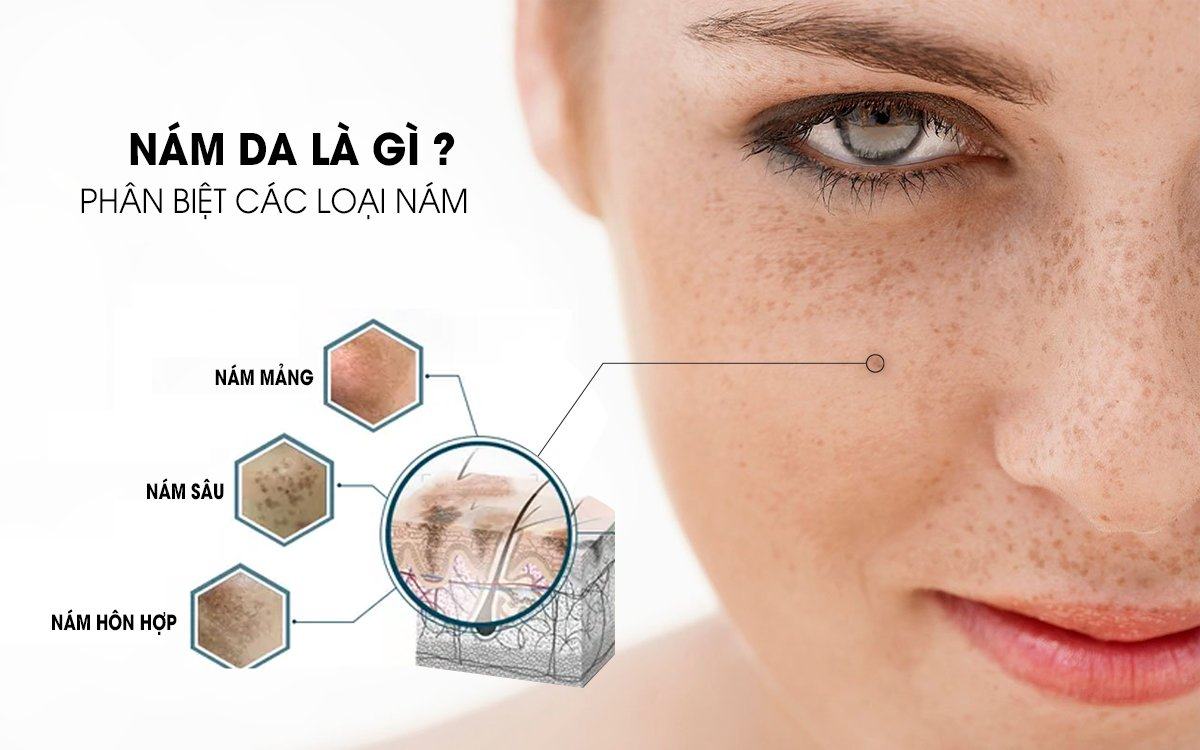 điều trị nám 01