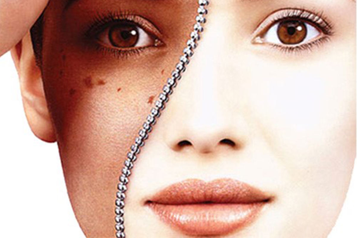 điều trị nám 03