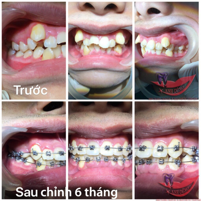 Trung tâm Nha khoa & Thẩm mỹ Anh Dũng-Top 3 Địa chỉ niềng răng uy tín nhất tỉnh Thái Bình